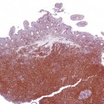 Mantle Cell Lymphoma 2